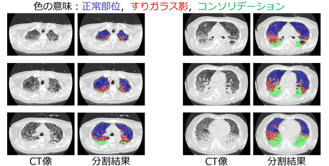 COVID-19 pneumonia classification